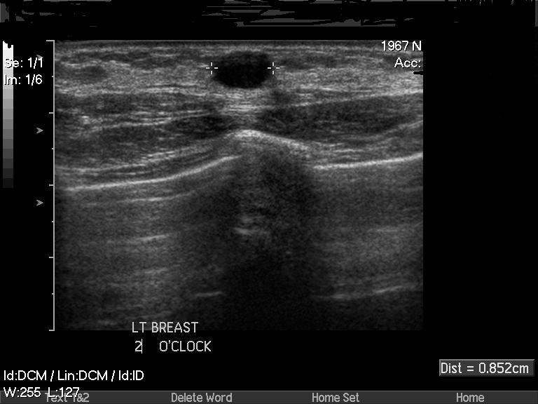 understanding-breast-cysts-total-health